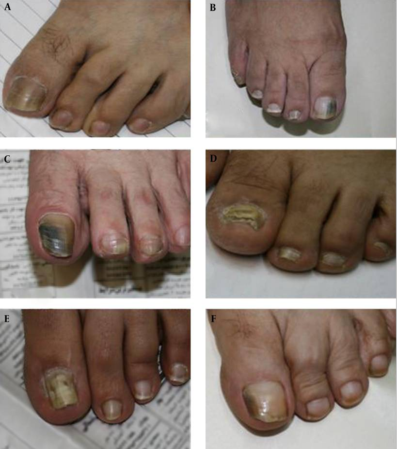 Fig 1 Onicomicosis por hongos no dermatofiticos